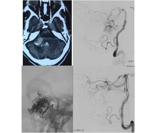 Intracranial AVM embolization