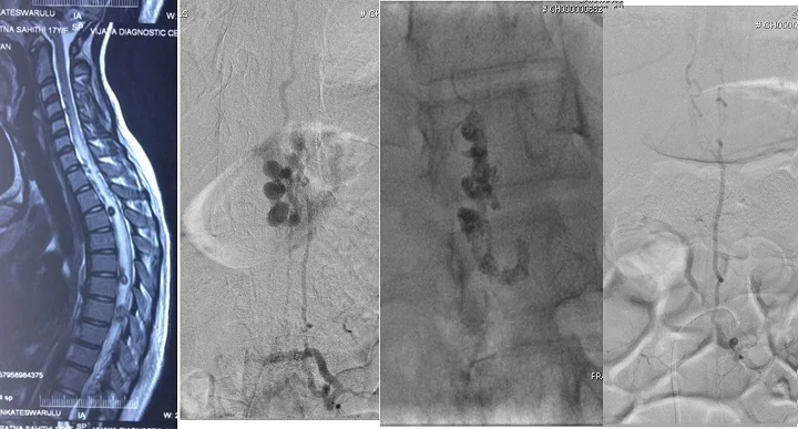 Glue embolization of spinal AVM
