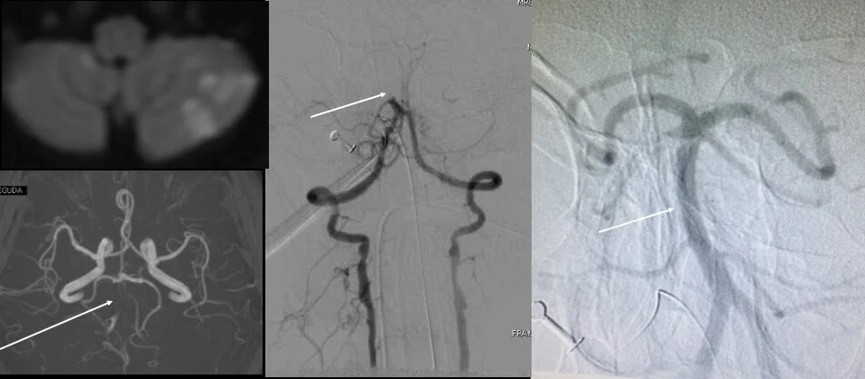 Posterior circulation stroke thrombectomy