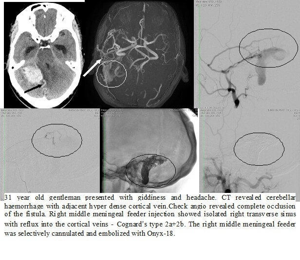 Embolization Procedure for AVM in India