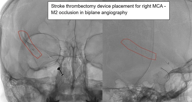 Bi-Plane Angiography Stroke Case