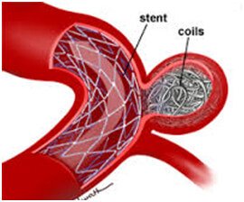Coiling For Aneurysms Treatment in Hyderabad