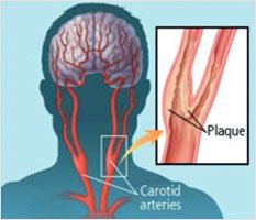 Carotid Stenting Treatment in Hyderabad