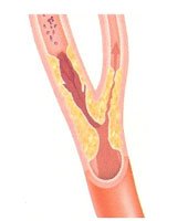 Carotid Stenosis Treatment in Hyderabad