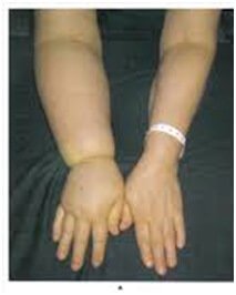 Renal Artery Embolization Procedure in Hyderabad