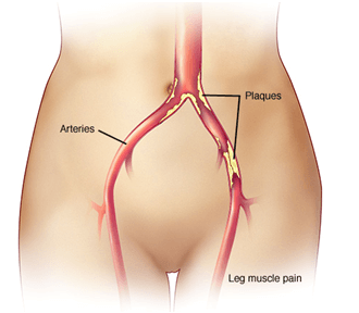 Peripheral Vascular Disease Treatment in Hyderabad