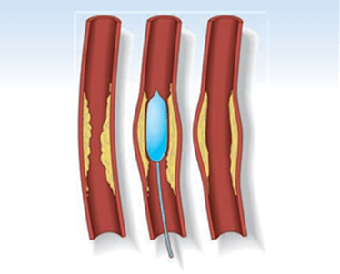 Peripheral Angioplasty Treatment in Hyderabad