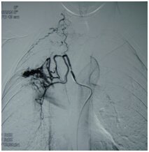 Embolization Procedure for AVM in India