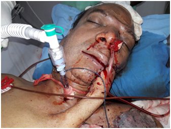 Emergency Facial Artery Embolization Case in Hyderabad