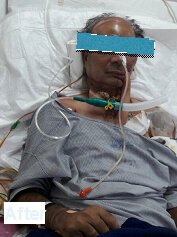 Carotid Blow-Out Treatment Case in Hyderabad
