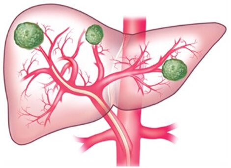 Liver Cancer Treatments in Hyderabad