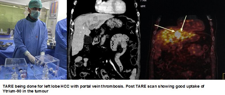TARE Procedure in Hyderabad