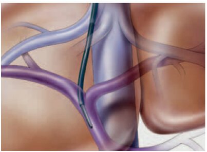 Portal Hypertension Treatment in Hyderabad