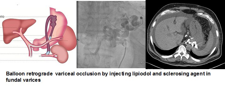 TIPSS Procedure in Hyderabad