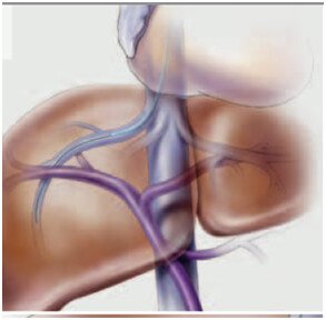 Budd-Chiari Syndrome Treatment in Hyderabad