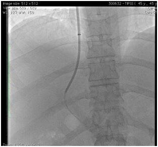 TIPSS for Cirrhosis with Portal Hypertension in Hyderabad