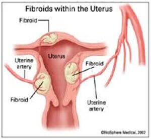 Uterine Fibroid Embolization Treatment in Hyderabad