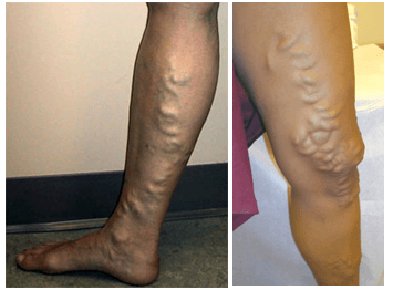 Varicose Veins Treatment in Hyderabad