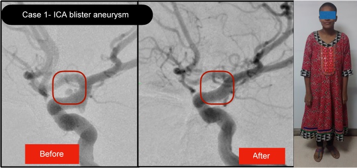 ICA blister aneurysm