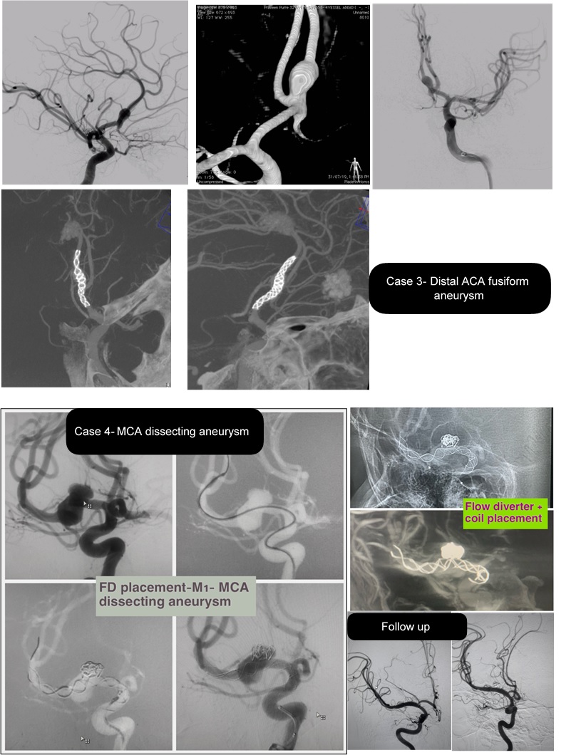 Distal ACA fusiform aneurysm
