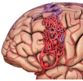 Dural AVM Treatment in Hyderabad