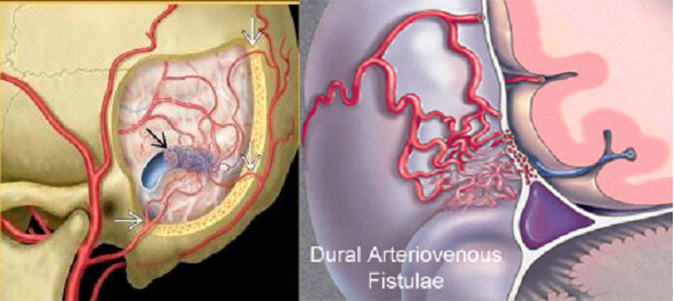 Spinal AVM in Hyderabad