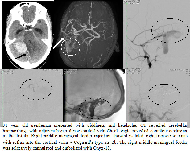 Embolization Procedure for AVM in India