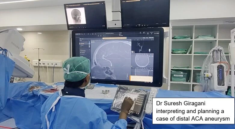 STENT ASSISTED COILING OF ICA ANEURYSM
