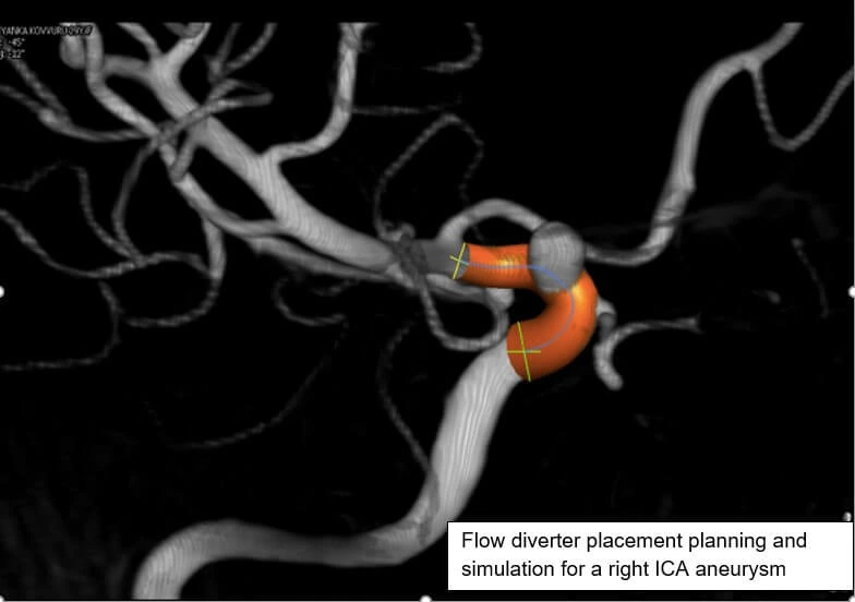 STENT ASSISTED COILING OF ICA ANEURYSM