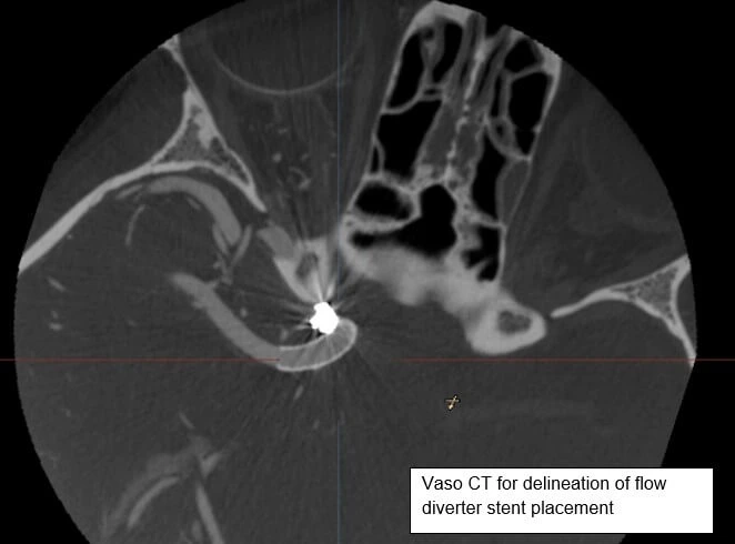STENT ASSISTED COILING OF ICA ANEURYSM
