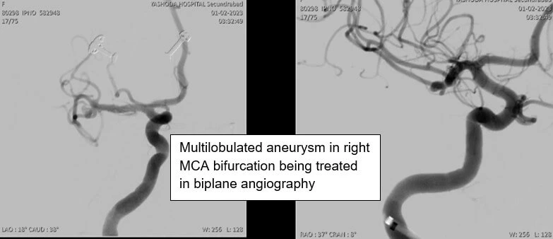 STENT ASSISTED COILING OF ICA ANEURYSM
