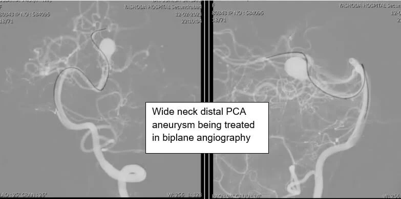 STENT ASSISTED COILING OF ICA ANEURYSM