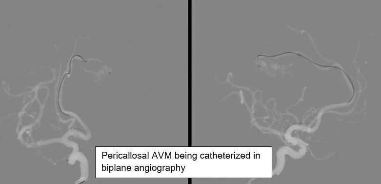 STENT ASSISTED COILING OF ICA ANEURYSM