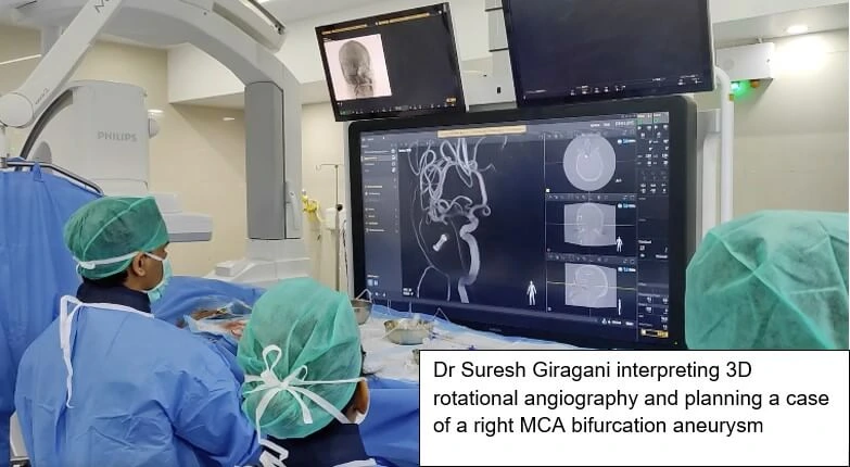 STENT ASSISTED COILING OF ICA ANEURYSM