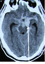 Coiling For Aneurysms Tratment in Hyderabad