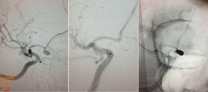 Coiling of the ruptured  Acom aneurysm