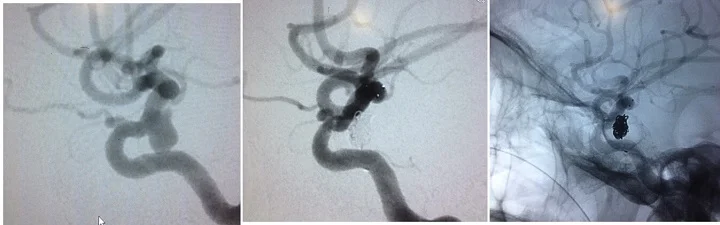 STENT ASSISTED COILING OF ICA ANEURYSM