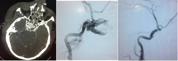 Intracranial AVM Embolization