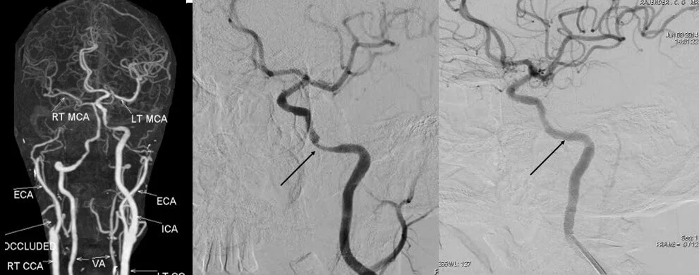 Embolization for Spinal AVM in Hyderabad