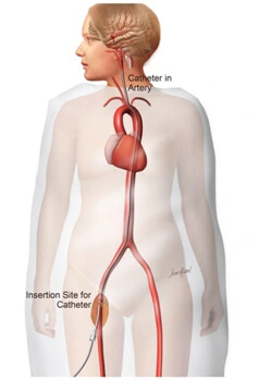 Cerebral Angiogram in Hyderabad