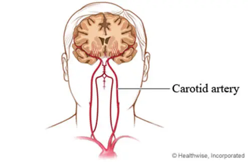 Brain Angiogram in Hyderabad