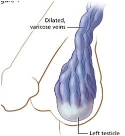Varicocele Embolization Treatment in Hyderabad