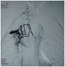 Embolization Procedure for AVM in India