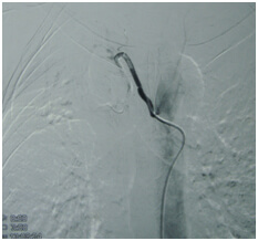 Embolization Procedure for AVM Hyderabad
