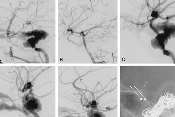 Embolization Procedure in Hyderabad