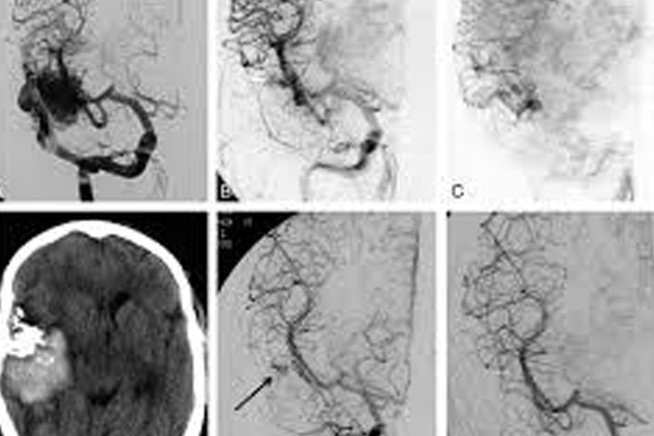 Embolization Procedure for AVM in India