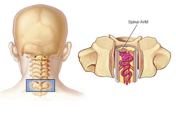 Embolization for Spinal AVM in Hyderabad