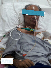 Embolization Procedure for AVM Hyderabad