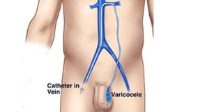 Varicocele Treatments in Hyderabad