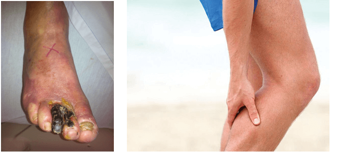 Vascular Interventional Treatments in Hyderabad